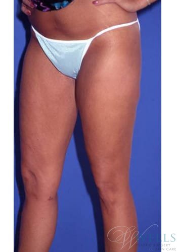 After Image: Liposuction - left-front-oblique