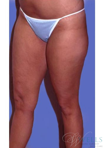 Before Image: Liposuction - left-front-oblique