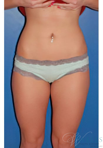 After Image: Liposuction - front