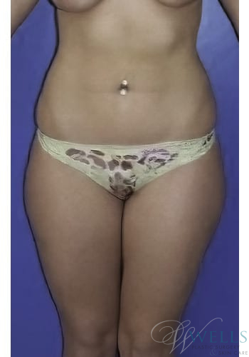 Before Image: Liposuction - front