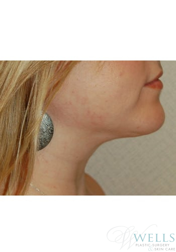 After Image: Liposuction - right-side