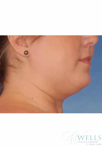 Before Image: Liposuction - right-side