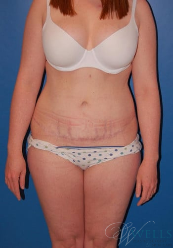 After Image: Lower Body Lift - front
