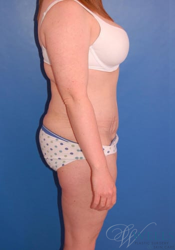 After Image: Lower Body Lift - right-side