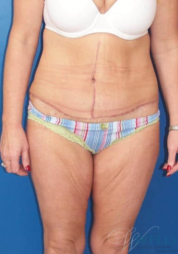 After Image: Lower Body Lift - front