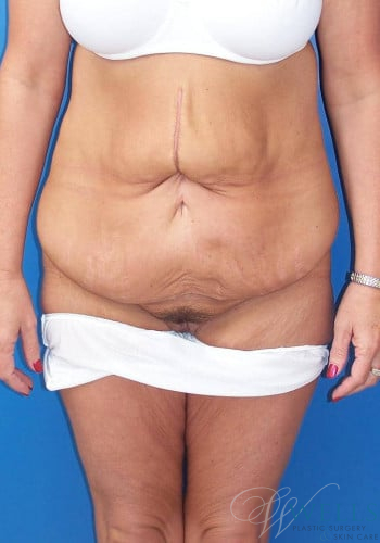 Before Image: Lower Body Lift - front
