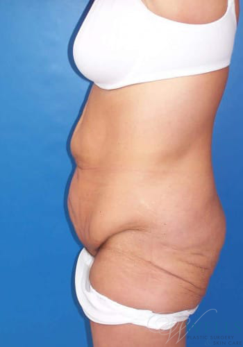 Before Image: Lower Body Lift - left-side