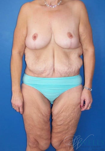Before Image: Lower Body Lift - front