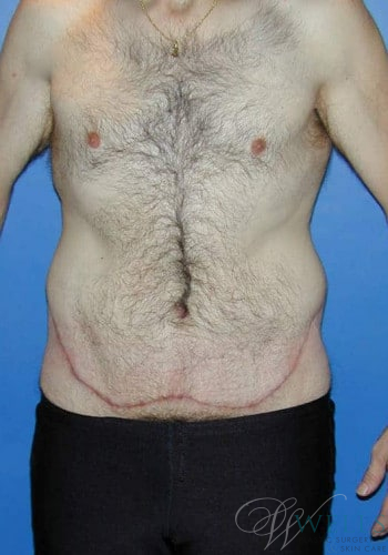 After Image: Lower Body Lift - front