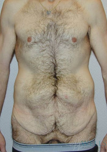 Before Image: Lower Body Lift - front