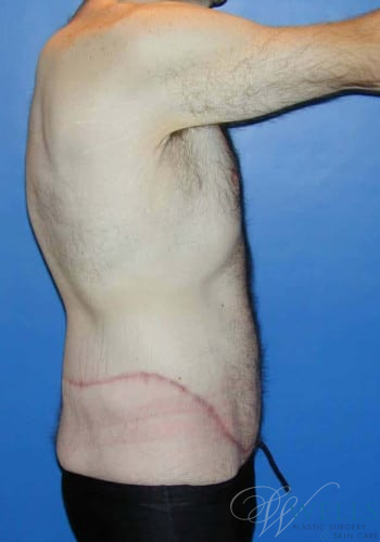 After Image: Lower Body Lift - right-side