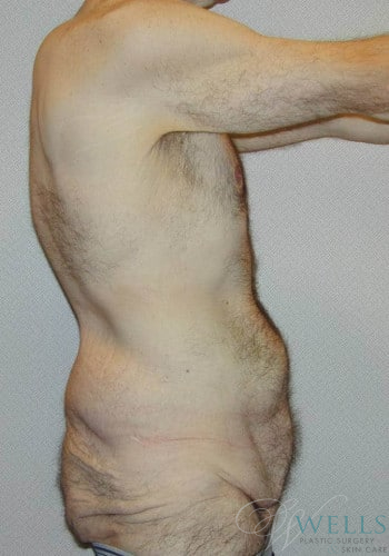 Before Image: Lower Body Lift - right-side