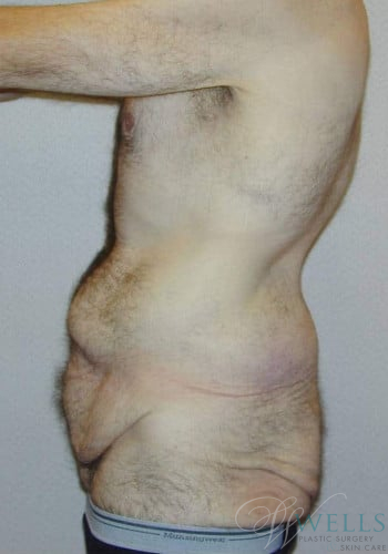 Before Image: Lower Body Lift - left-side