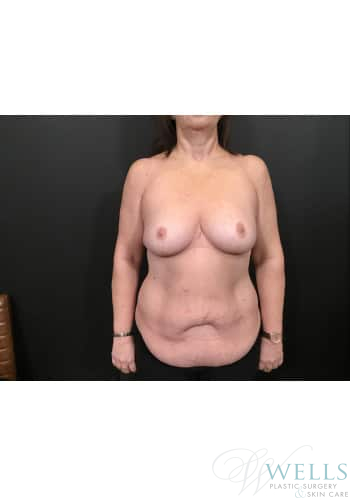 Before Image: Mommy Makeover - front