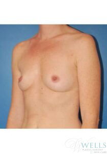 Before Image: Breast Augmentation