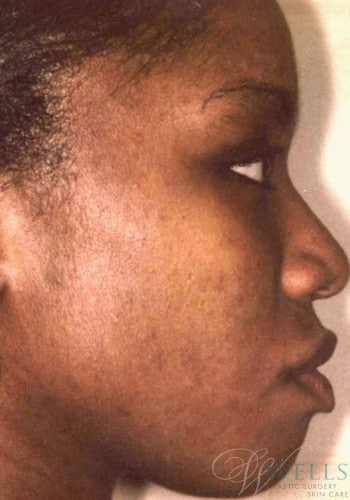 After Image: Acne Treatment - right-side