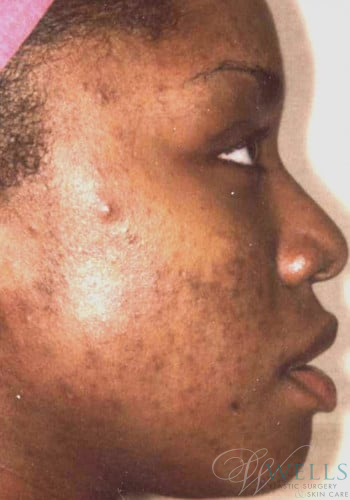 Before Image: Acne Treatment - right-side