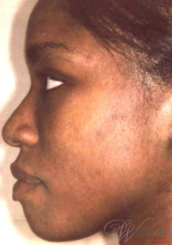 After Image: Acne Treatment - left-side
