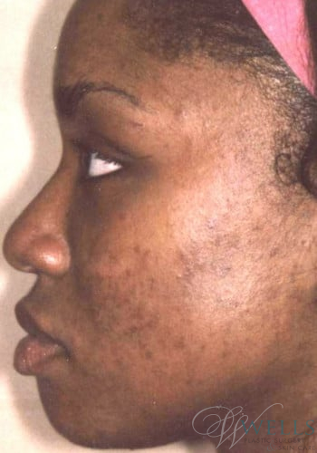 Before Image: Acne Treatment - left-side