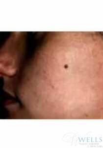 After Image: Acne Treatment