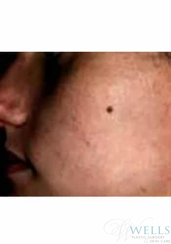 After Image: Acne Treatment - other