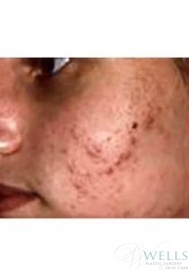 Before Image: Acne Treatment