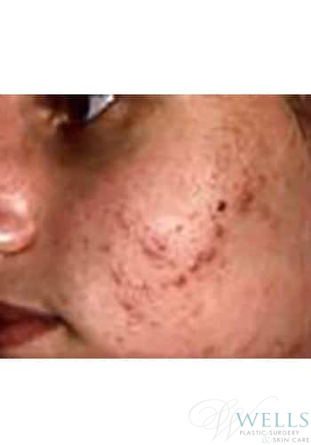 Before Image: Acne Treatment - other