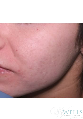After Image: Acne Treatment - left-front-oblique