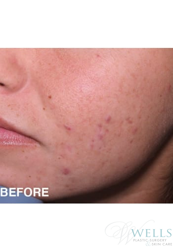 Before Image: Acne Treatment - left-front-oblique