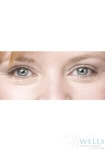 After Image: Blepharoplasty