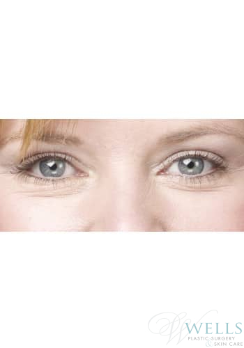 After Image: Blepharoplasty - front
