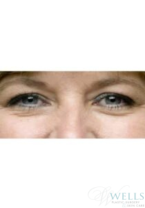 Before Image: Blepharoplasty