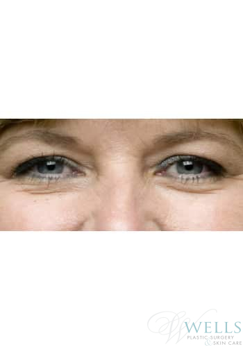 Before Image: Blepharoplasty - front