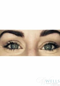 After Image: Blepharoplasty