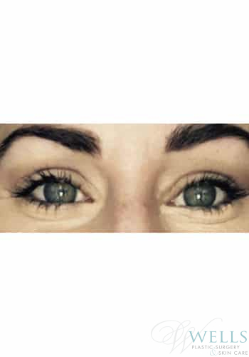 After Image: Blepharoplasty - front