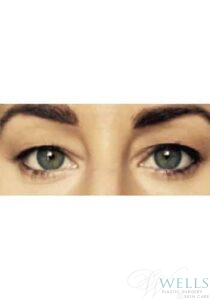 Before Image: Blepharoplasty