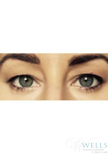 Before Image: Blepharoplasty - front