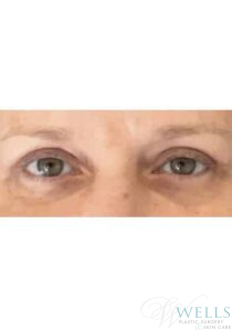After Image: Blepharoplasty