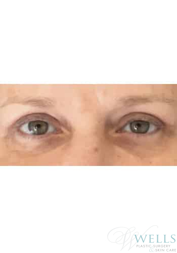 After Image: Blepharoplasty - front