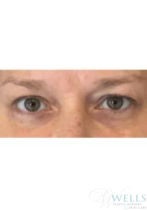 Before Image: Blepharoplasty
