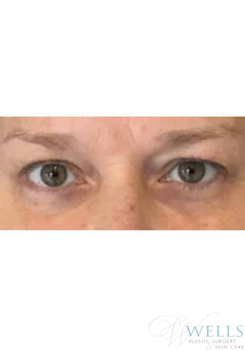 Before Image: Blepharoplasty - front