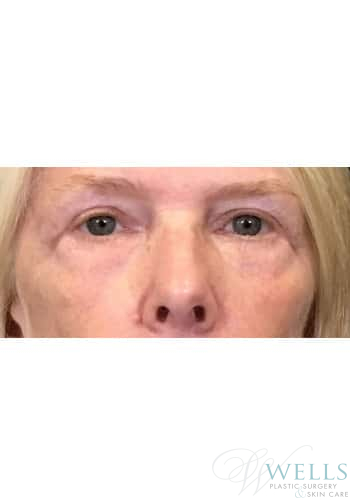 After Image: Blepharoplasty - front