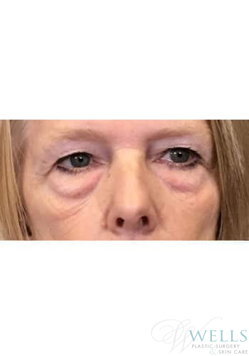 Before Image: Blepharoplasty - front