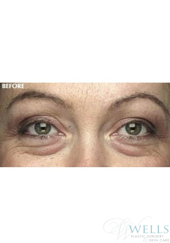 Before Image: Blepharoplasty - front