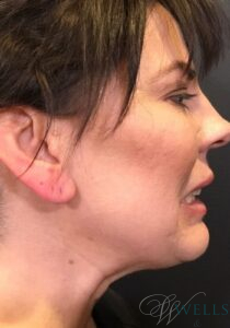 After Image: Botox