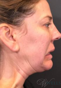 Before Image: Botox