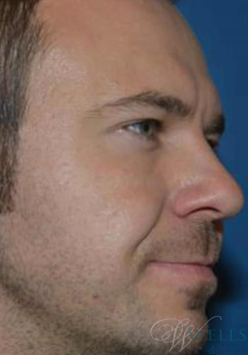 After Image: Botox - right-front-oblique