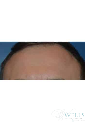 After Image: Botox - front