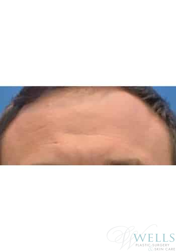 Before Image: Botox - front
