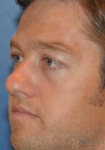 After Image: Botox - left-front-oblique